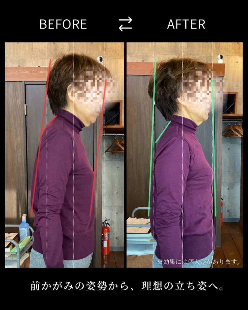 国分寺 整体 ユルノテ国分寺 猫背・巻肩ビフォーアフター4